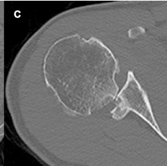 Posterior Glenoid Deficiency